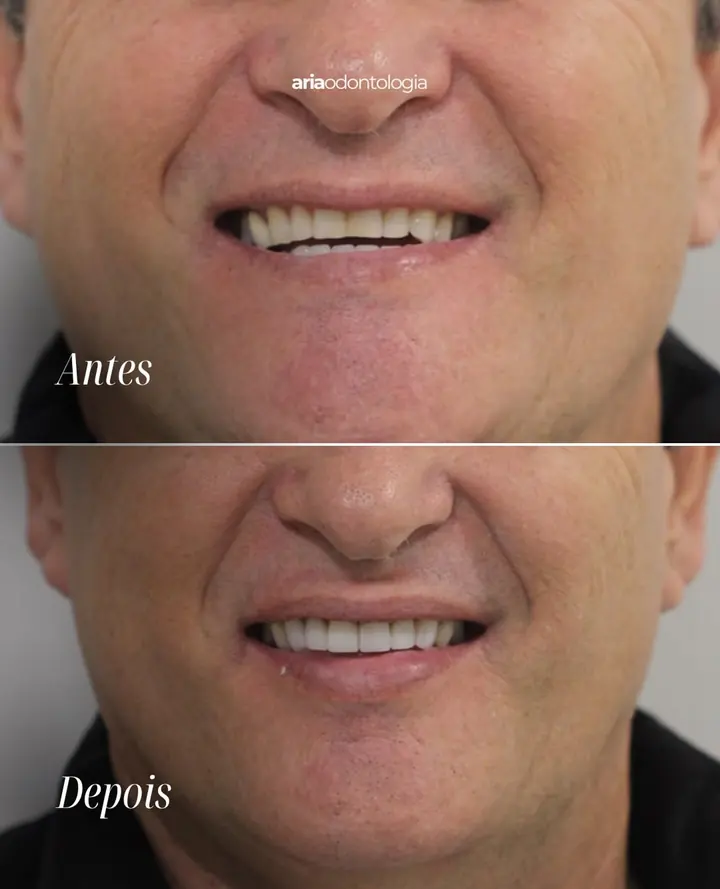 Sorriso antes e depois do tratamento